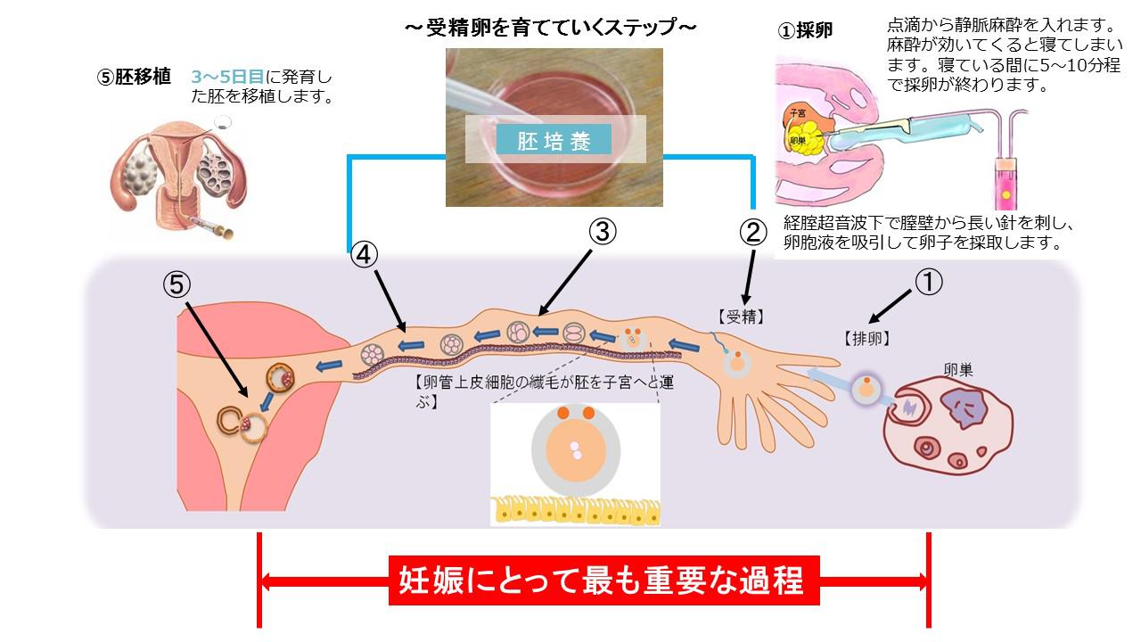 体外受精の適応４.jpg