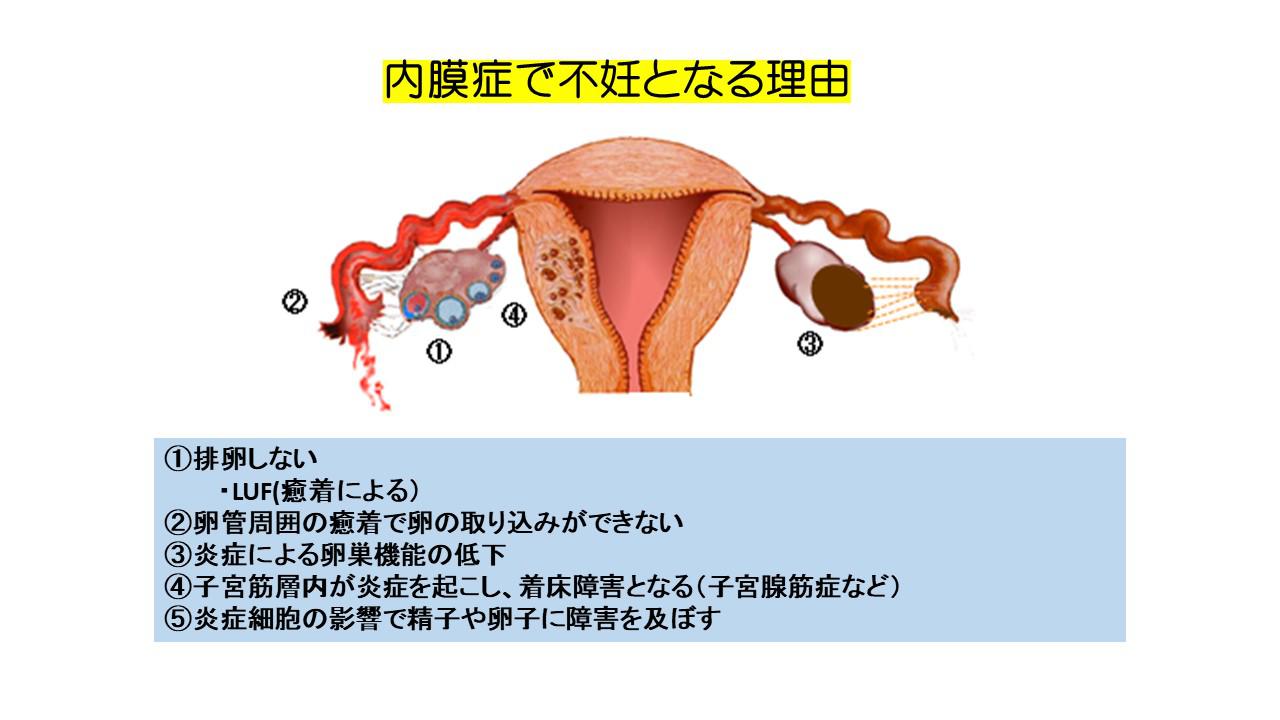 不妊原因と検査.jpg